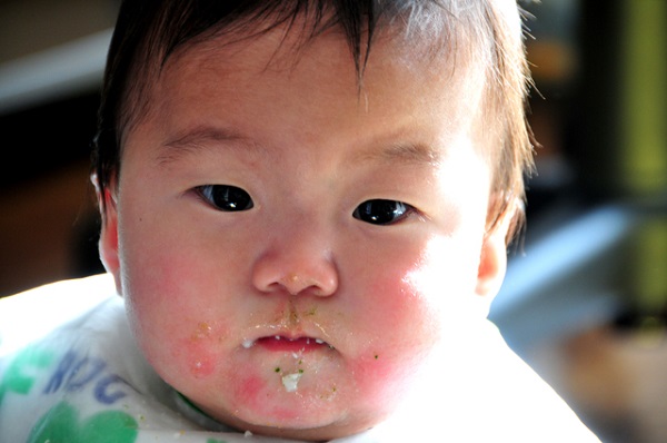 新生児の乳児湿疹、原因は母乳？保湿とケア方法│AMOMA
