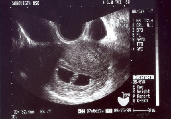 助産師監修 妊娠6週目 妊娠2ヶ月 エコー写真 心拍確認やつわり 出血について