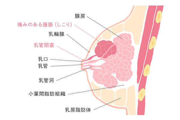 乳腺炎におけるしこり