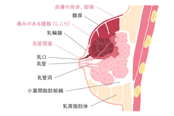 乳腺炎における膿