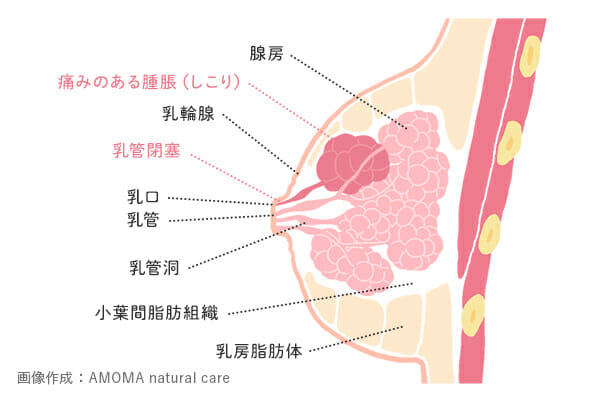 乳腺炎におけるしこり