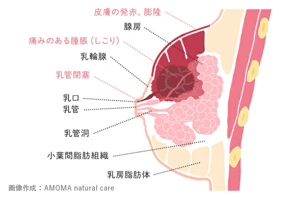 乳腺炎における膿