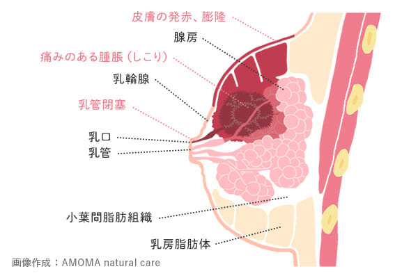 医師監修 乳腺炎の症状とは しこり 熱 頭痛 高熱 白斑について 体験談あり